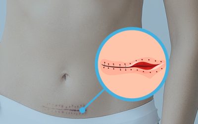 Deiscência da sutura e suas complicações