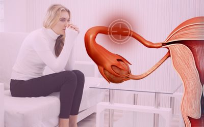 Obstrução das tubas uterinas: o que é e como tratar?
