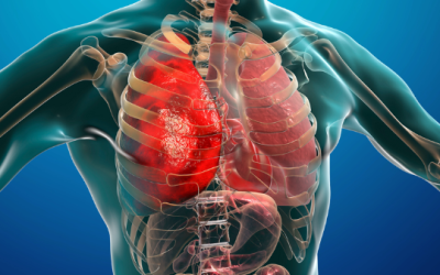 Prevenção de Embolia Pulmonar em Cirurgias Plásticas